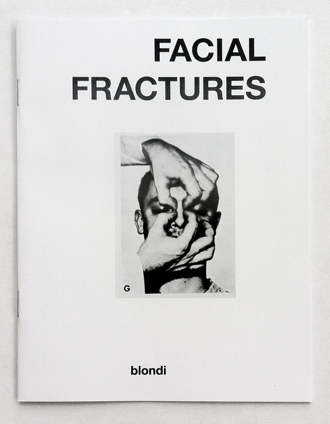 Facial Fractures